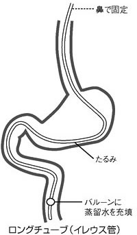 図３．従来の消化管減圧法（イレウス管）