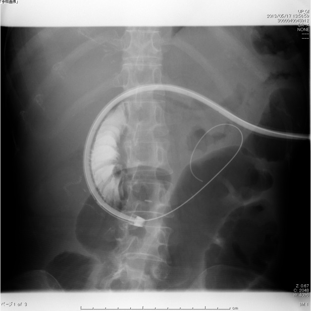 レントゲン透視下で胃瘻の瘻孔（穴）から十二指腸→小腸に挿入した柔らかいガイドワイヤーに沿ってチューブを進めていく（左）
